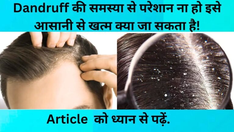 Anti dandruff shampoo: लगाने की जरूरत नहीं 100% dandruff हमेशा के लिए खत्म हो जाएगा!