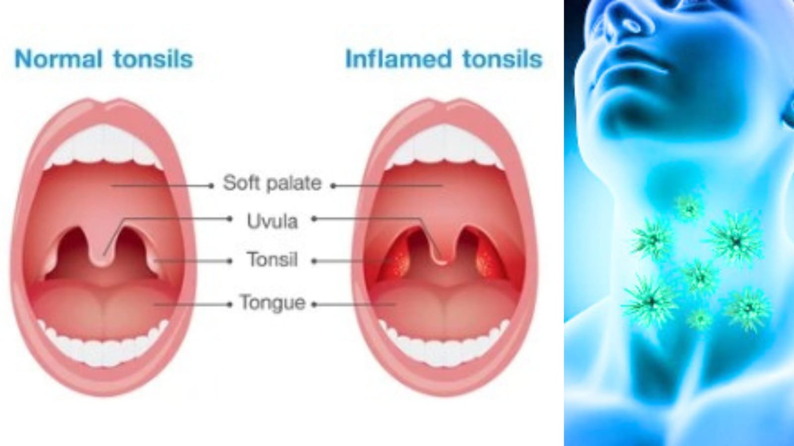 Tonsils 
